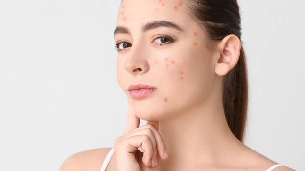 Frustrated by Acne and Inflammation? The Skincare Routine That Finally Makes a Difference