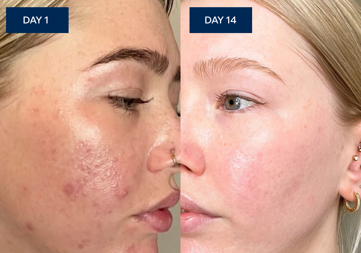 Sue's face on Day 1 with visible puffiness