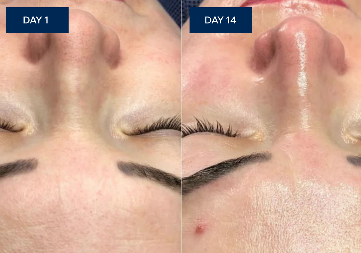 Sue's face on Day 1 with visible puffiness
