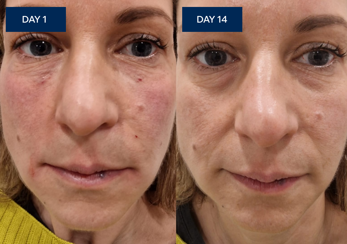 Sue's face on Day 1 with visible puffiness