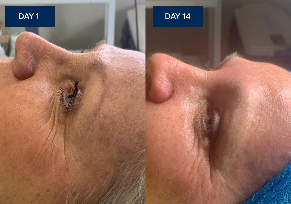 Sue's face on Day 1 with visible puffiness