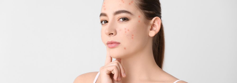 Frustrated by Acne and Inflammation? The Skincare Routine That Finally Makes a Difference